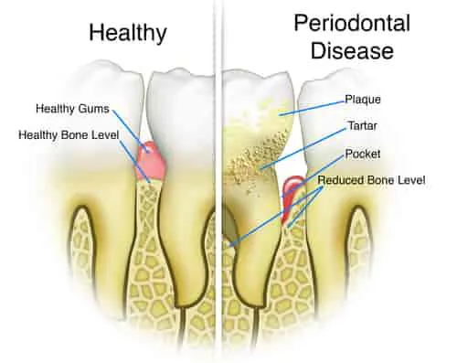 root planing gum disease