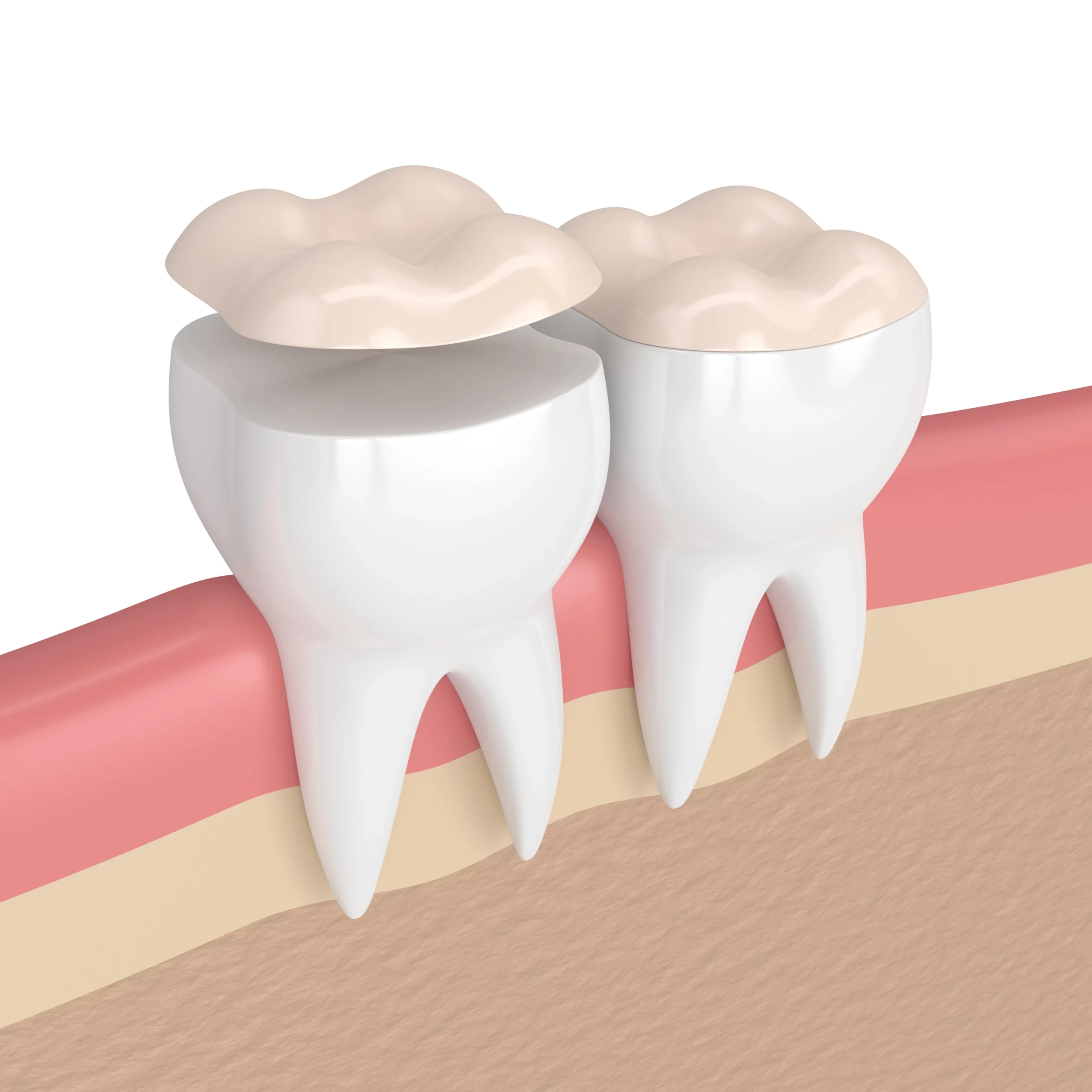 Dental inlays & Onlays