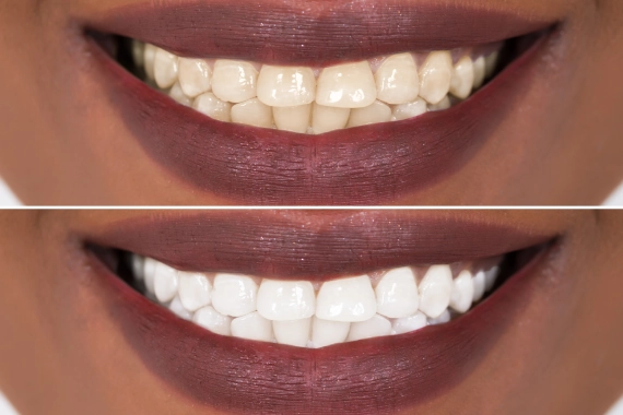 How long does teeth whitening last before after