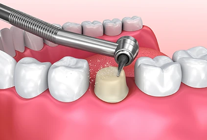 is dental crown removal painful